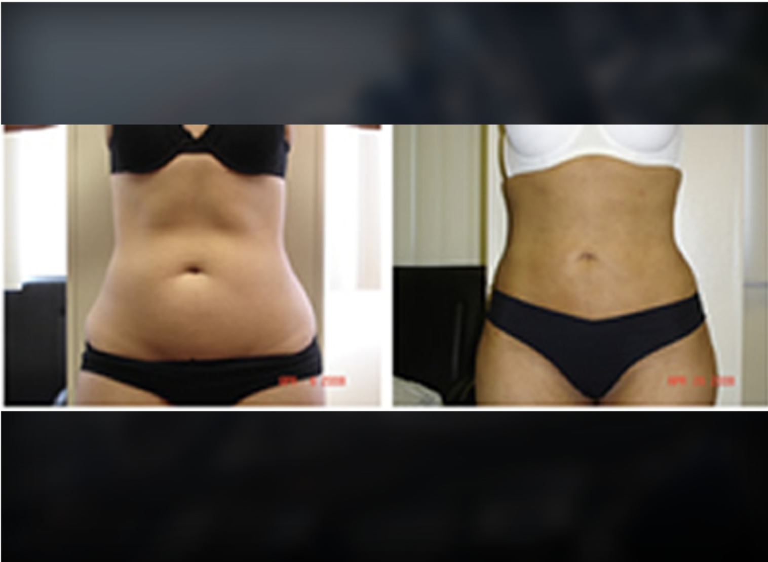 Breast Augmentation before and after