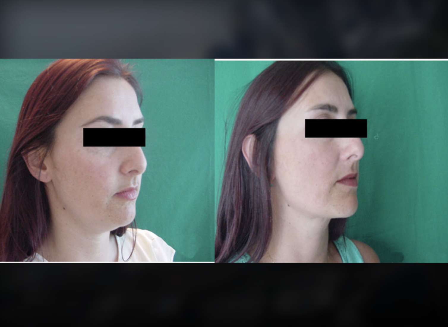 Liposuction before and after