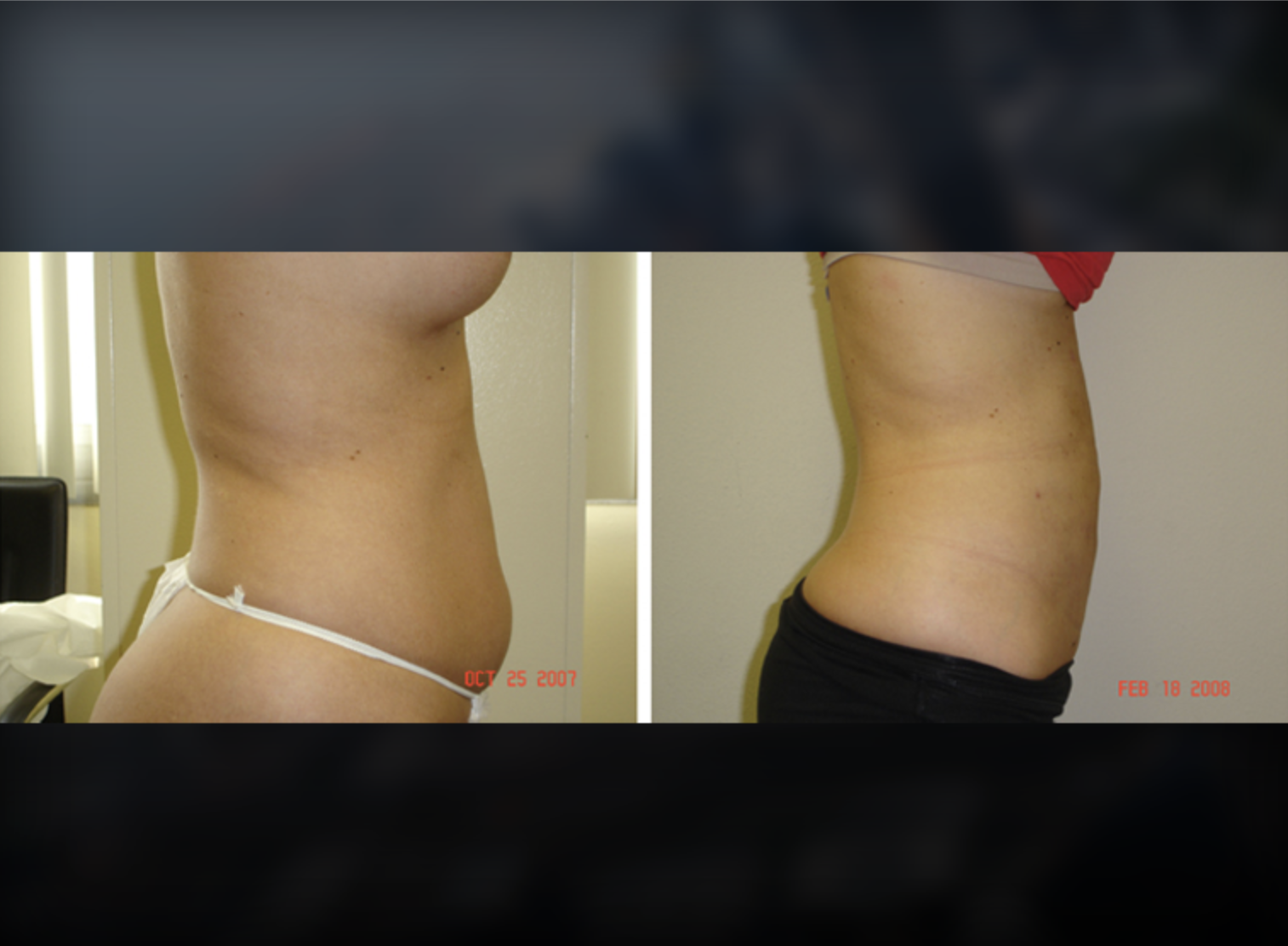 Tummy Tuck before and after